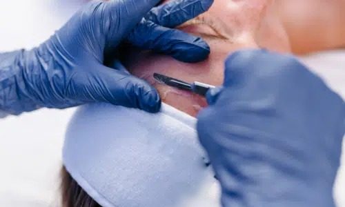 Dermaplaning behandeling bij Bij Viv